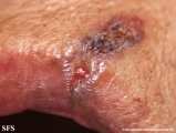 basal cell carcinoma