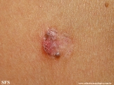 basal cell carcinoma