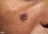 basal cell carcinoma
