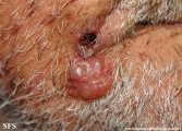 basal cell carcinoma