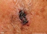 basal cell carcinoma
