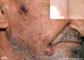 basal cell carcinoma
