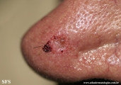 basal cell carcinoma