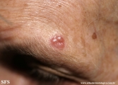 basal cell carcinoma