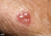 basal cell carcinoma