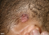 basal cell carcinoma