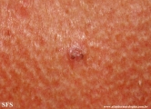 basal cell carcinoma