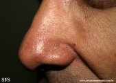 basal cell carcinoma