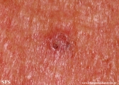basal cell carcinoma