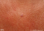basal cell carcinoma