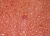 basal cell carcinoma