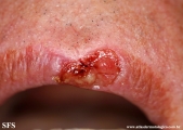 basal cell carcinoma