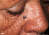 basal cell carcinoma