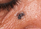 basal cell carcinoma