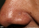basal cell carcinoma