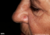 basal cell carcinoma
