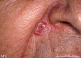 basal cell carcinoma