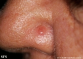 basal cell carcinoma