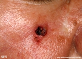 basal cell carcinoma