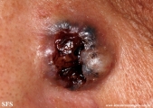 basal cell carcinoma