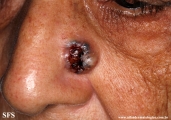 basal cell carcinoma
