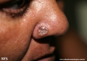 basal cell carcinoma