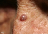 basal cell carcinoma