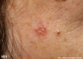 basal cell carcinoma
