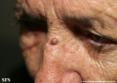 basal cell carcinoma