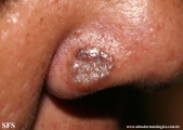basal cell carcinoma
