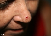basal cell carcinoma