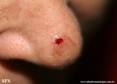 basal cell carcinoma