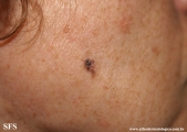 basal cell carcinoma
