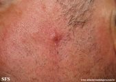 basal cell carcinoma