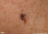 basal cell carcinoma