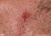 basal cell carcinoma