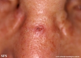 basal cell carcinoma