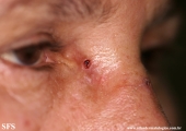 basal cell carcinoma