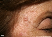 basal cell carcinoma