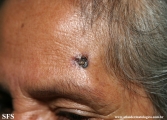 basal cell carcinoma