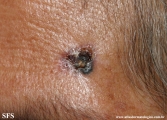 basal cell carcinoma
