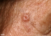 basal cell carcinoma