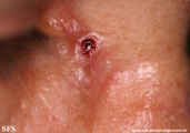 basal cell carcinoma