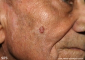 basal cell carcinoma