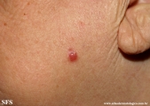basal cell carcinoma