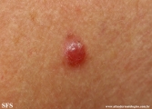 basal cell carcinoma