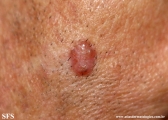 basal cell carcinoma