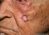 basal cell carcinoma