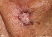 basal cell carcinoma
