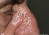 basal cell carcinoma